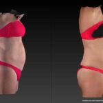 Before & After - Ultra Slim Treatment