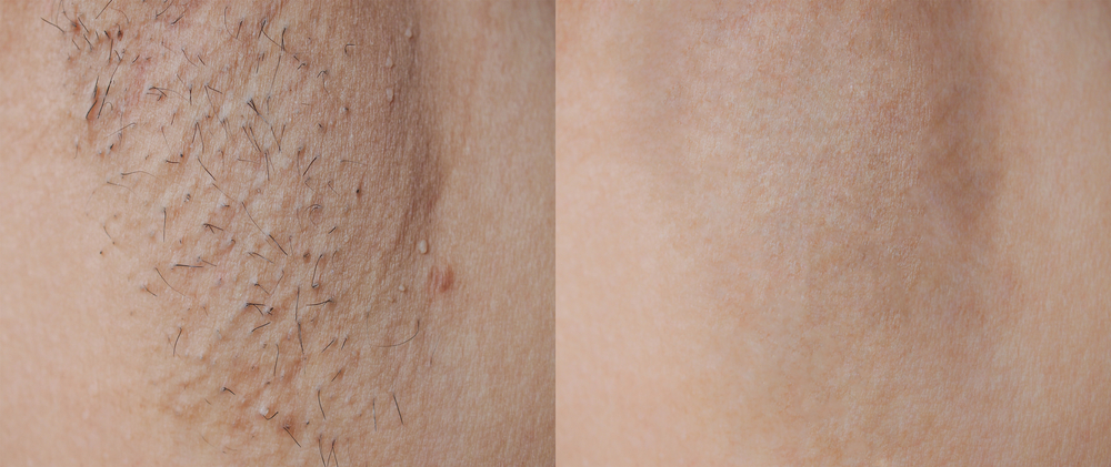 Before and after results of underarm laser hair removal showing hairless skin.